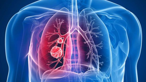 Image20260305-lungcancer